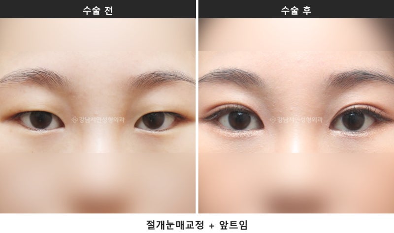 앞트임과 눈매교정 병행, 시원한 눈매를 만드는 조합입니다 사진 2