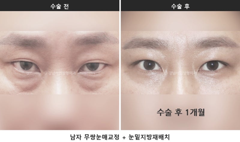 안검하수 뜻, 눈 뜨는 힘이 약해 눈이 가려지는 상태입니다 사진 5