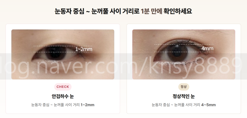 안검하수 뜻, 눈 뜨는 힘이 약해 눈이 가려지는 상태입니다 사진 2