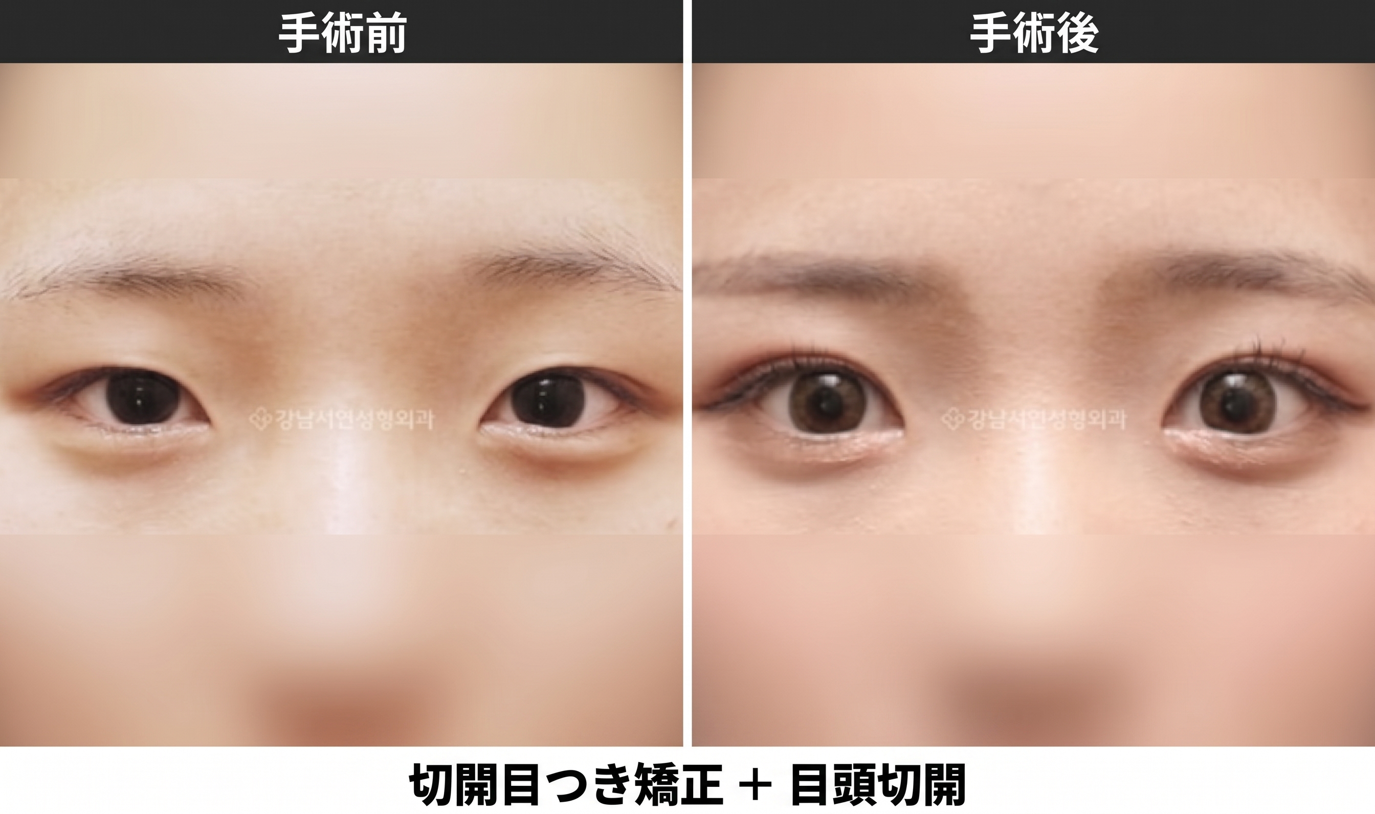 眼瞼下垂の意味とは？まぶたを開ける力が弱まり黒目が隠れる状態です