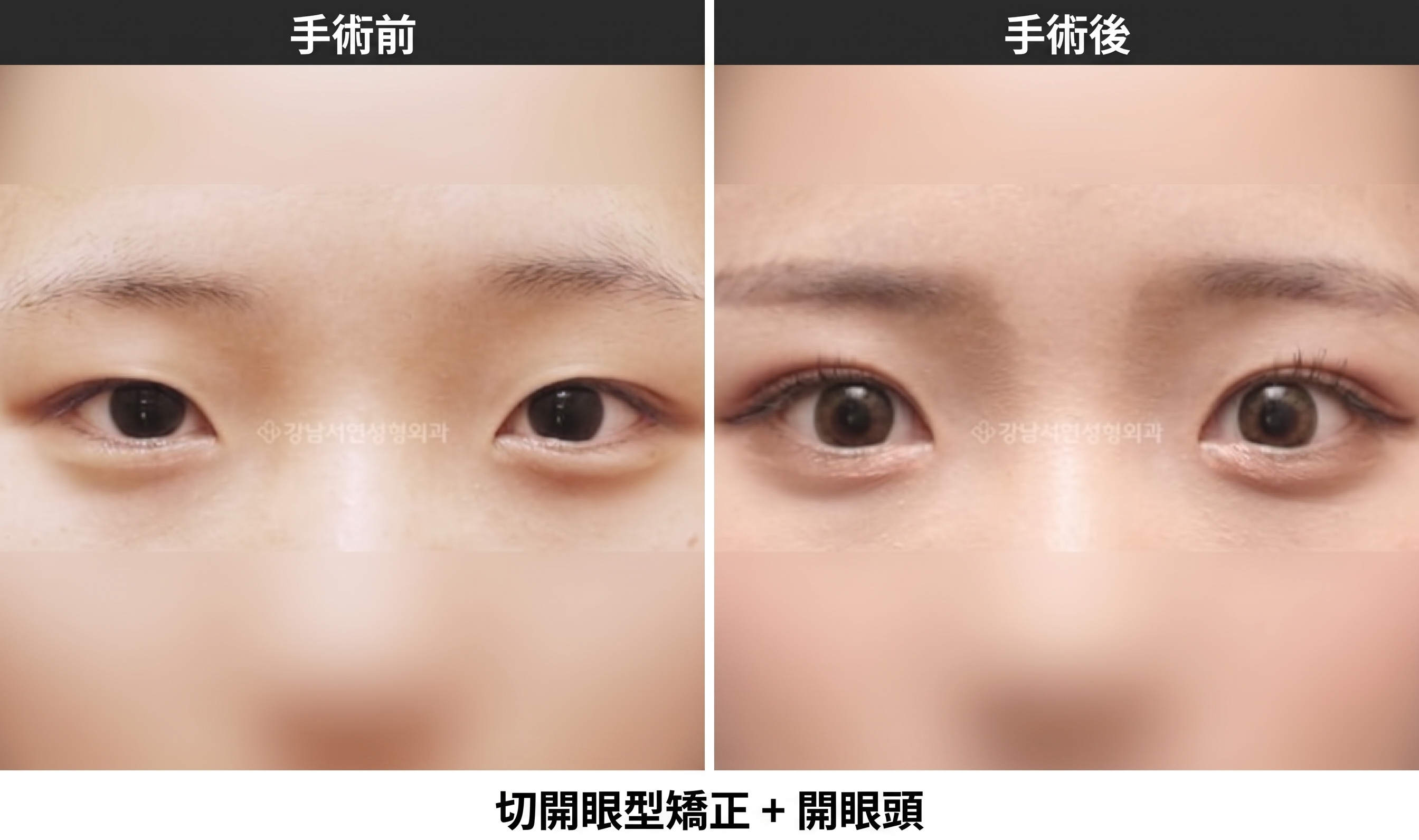 眼瞼下垂是什麼意思？睜眼力減弱、眼睛被遮住的狀態