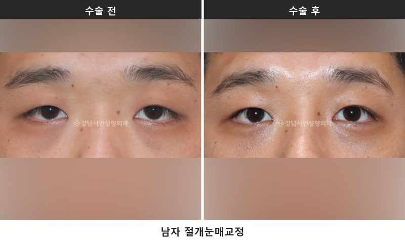 안검하수 뜻, 눈 뜨는 힘이 약해 눈이 가려지는 상태입니다 사진 9