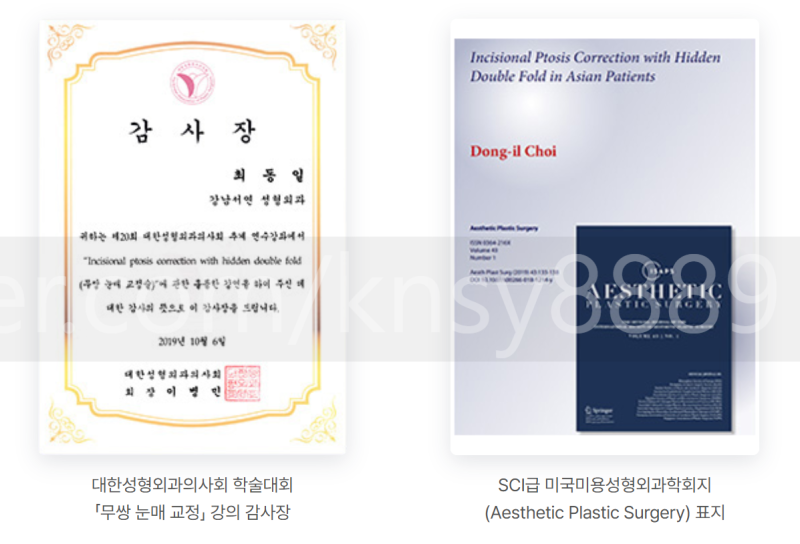 안검하수 뜻, 눈 뜨는 힘이 약해 눈이 가려지는 상태입니다 사진 7