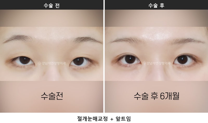 쌍수 붓기 기간, 붓기 짝짝이는 언제까지 정상일까요 사진 2