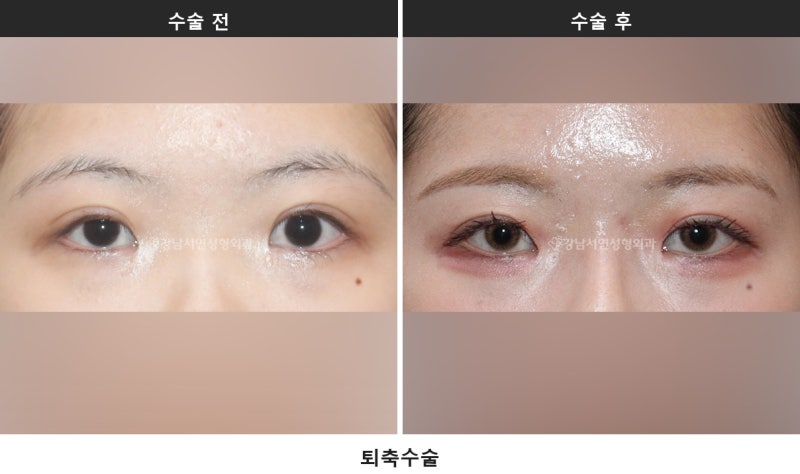 쌍수 붓기 기간, 붓기 짝짝이는 언제까지 정상일까요 사진 4