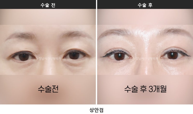 쌍수 붓기 기간, 붓기 짝짝이는 언제까지 정상일까요 사진 7