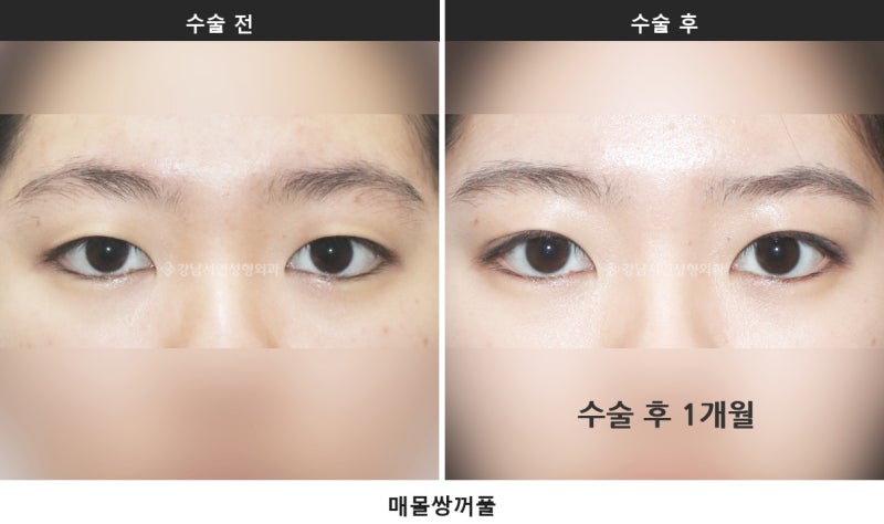 쌍수 붓기 기간, 붓기 짝짝이는 언제까지 정상일까요 사진 3