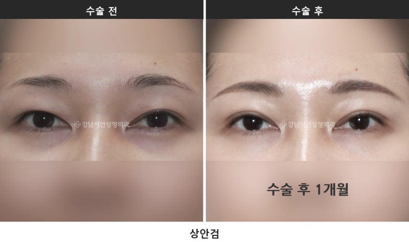 쌍수 붓기 기간, 붓기 짝짝이는 언제까지 정상일까요 사진 5