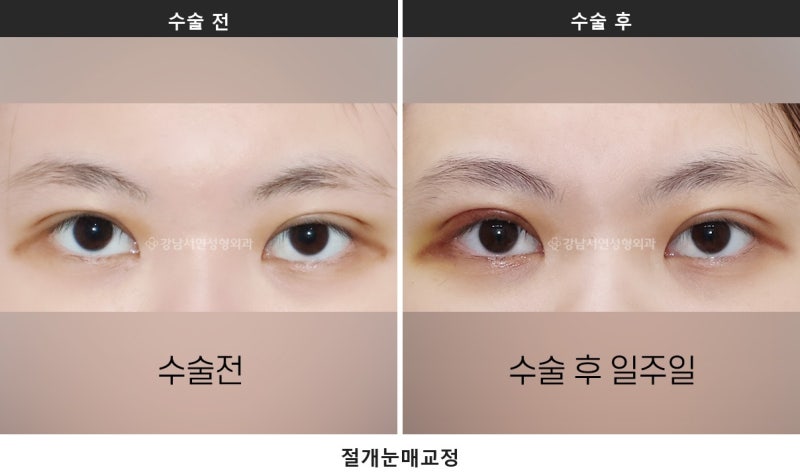쌍수 붓기 기간, 붓기 짝짝이는 언제까지 정상일까요 사진 6