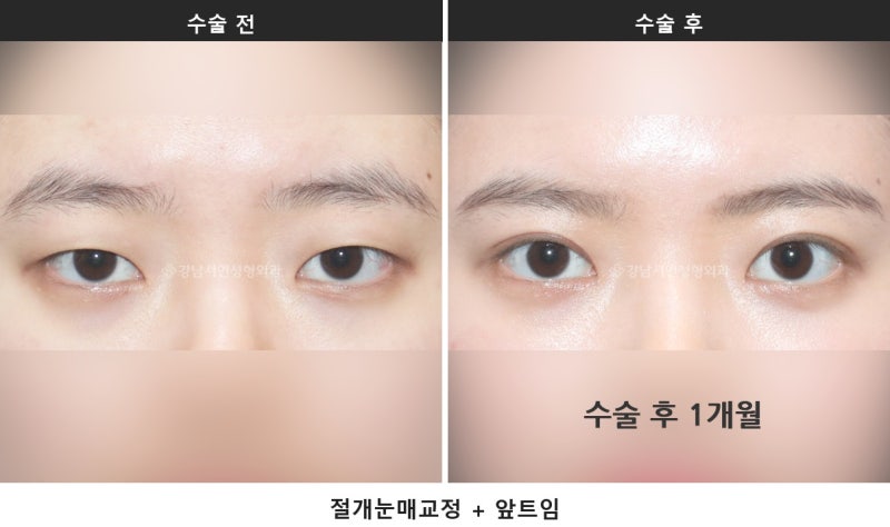 쌍수 붓기 기간, 붓기 짝짝이는 언제까지 정상일까요