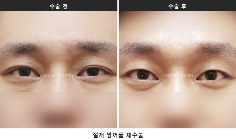 雙眼皮修正手術，諮詢時最常被問的7個問題整理 사진 4