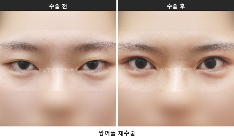 雙眼皮修正手術，諮詢時最常被問的7個問題整理 사진 6