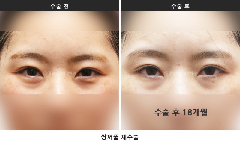 雙眼皮修正手術，諮詢時最常被問的7個問題整理 사진 3