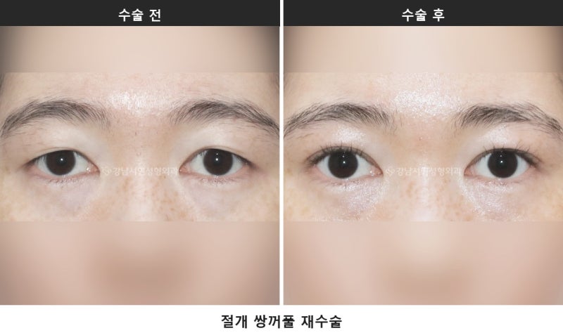 雙眼皮修正手術，諮詢時最常被問的7個問題整理 사진 5