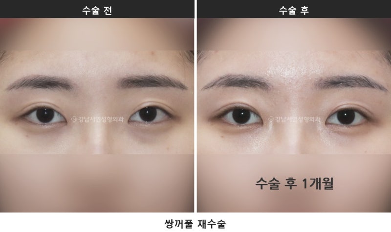 雙眼皮修正手術，諮詢時最常被問的7個問題整理 사진 2