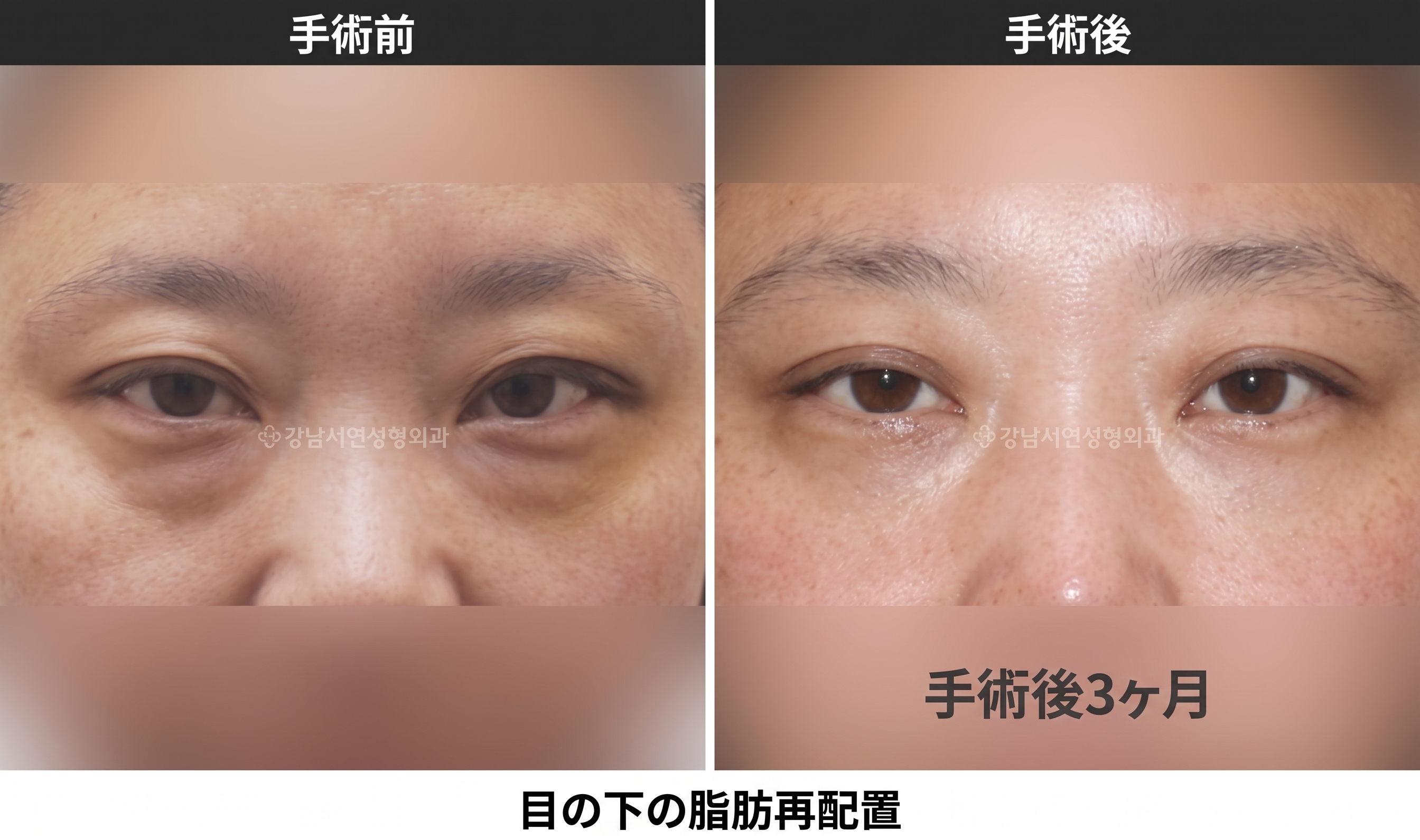中年の目の下がふくらみ影に見えるなら、目の下の脂肪再配置と下眼瞼形成術のどちらが合うか