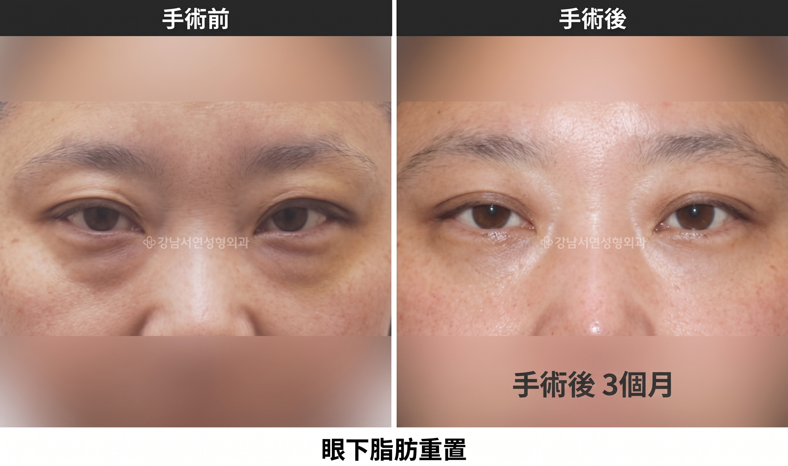 中年後眼下隆起又顯陰影？眼下脂肪重排與下眼瞼整形該如何選擇