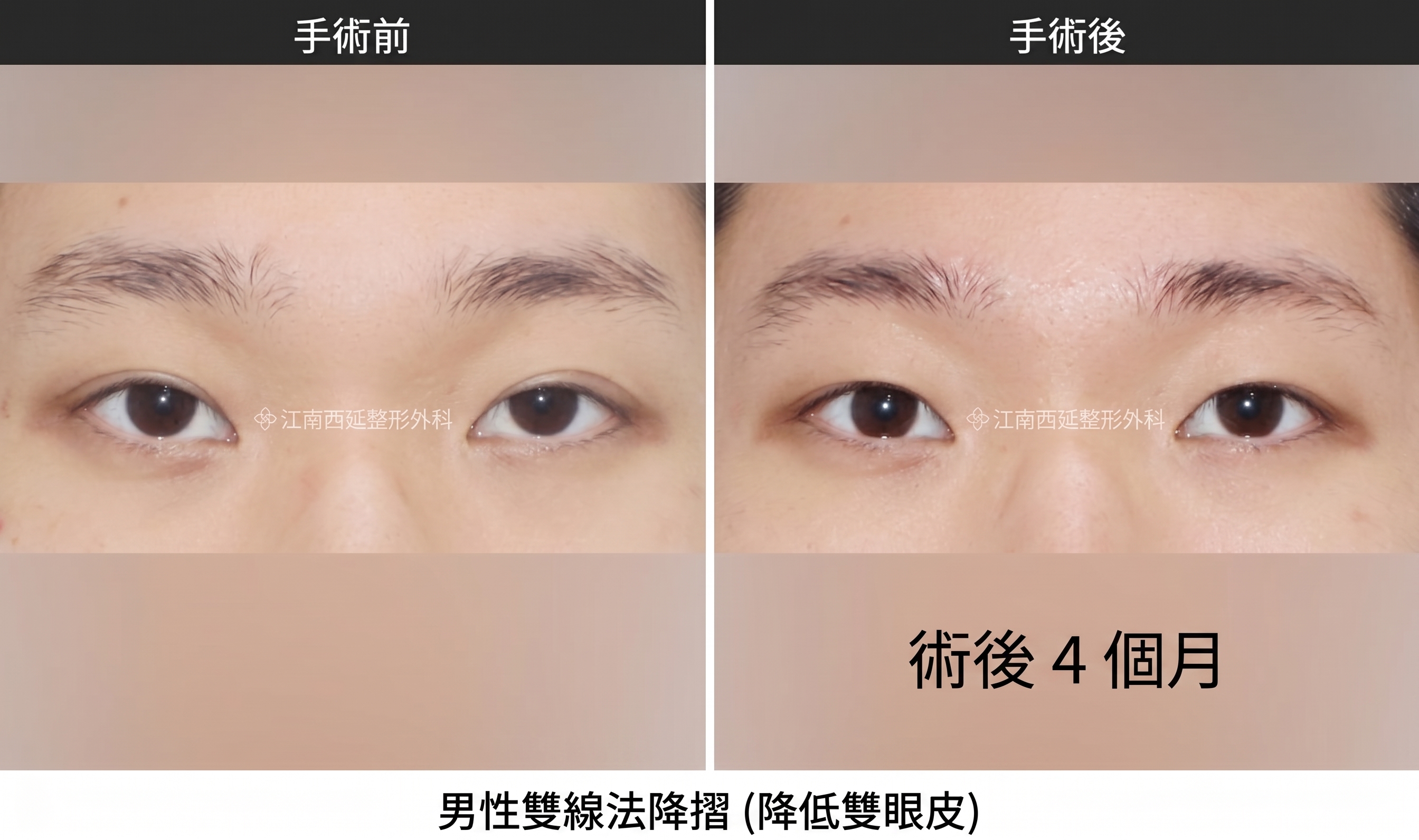 男性雙眼皮去除,門診常見問題整理