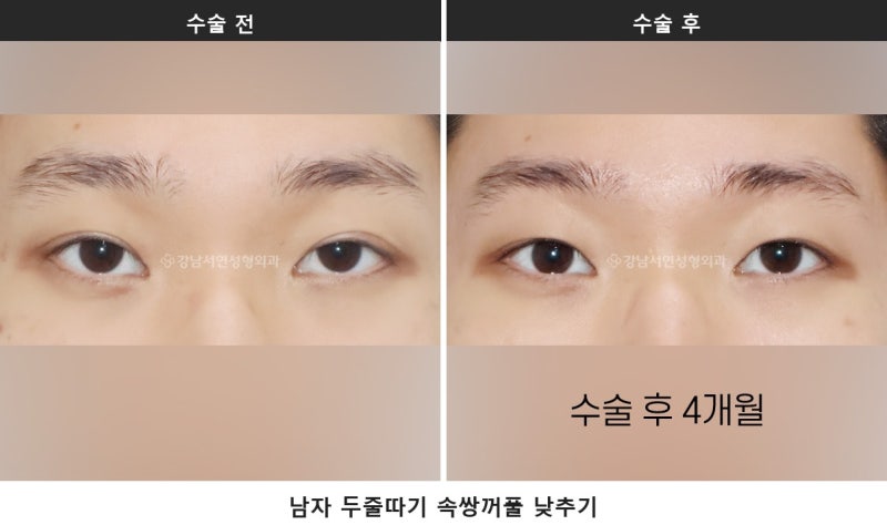 남자 쌍꺼풀 제거, 진료실에서 자주 나오는 질문을 정리했습니다