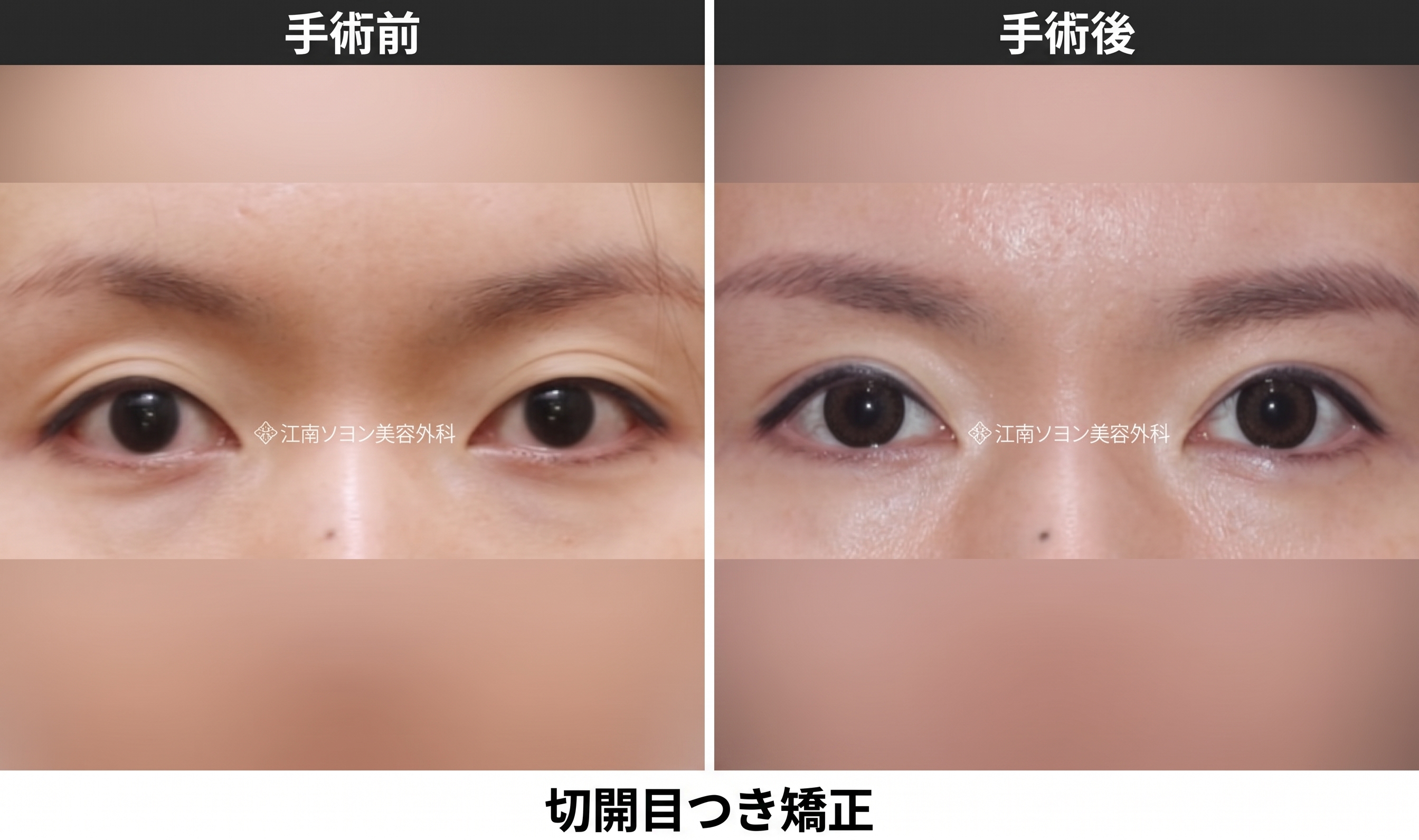 目元矯正術とは?まぶたを開く力を整える手術です