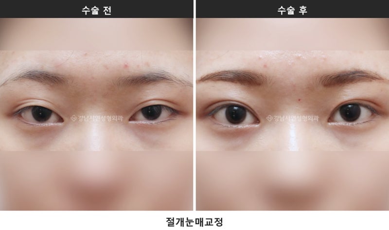 눈매교정술, 눈 뜨는 힘을 바로잡는 수술입니다 사진 6