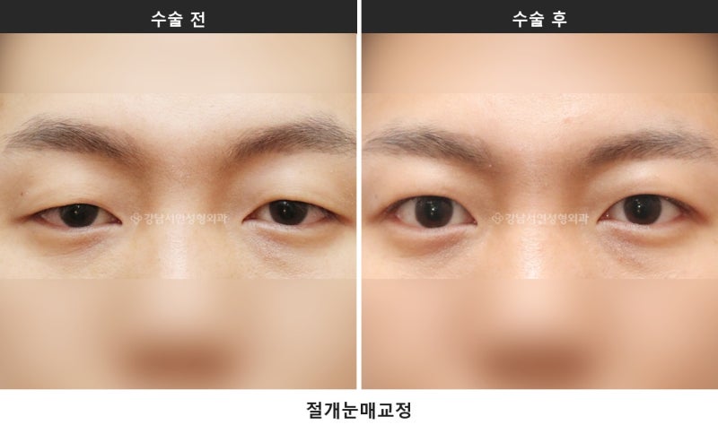 눈매교정술, 눈 뜨는 힘을 바로잡는 수술입니다 사진 5