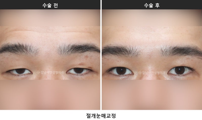 눈매교정술, 눈 뜨는 힘을 바로잡는 수술입니다 사진 3