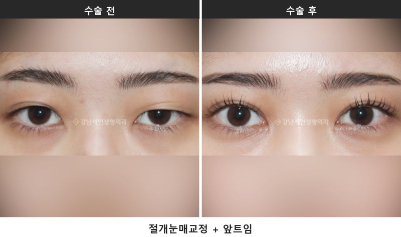 눈매교정술, 눈 뜨는 힘을 바로잡는 수술입니다 사진 7