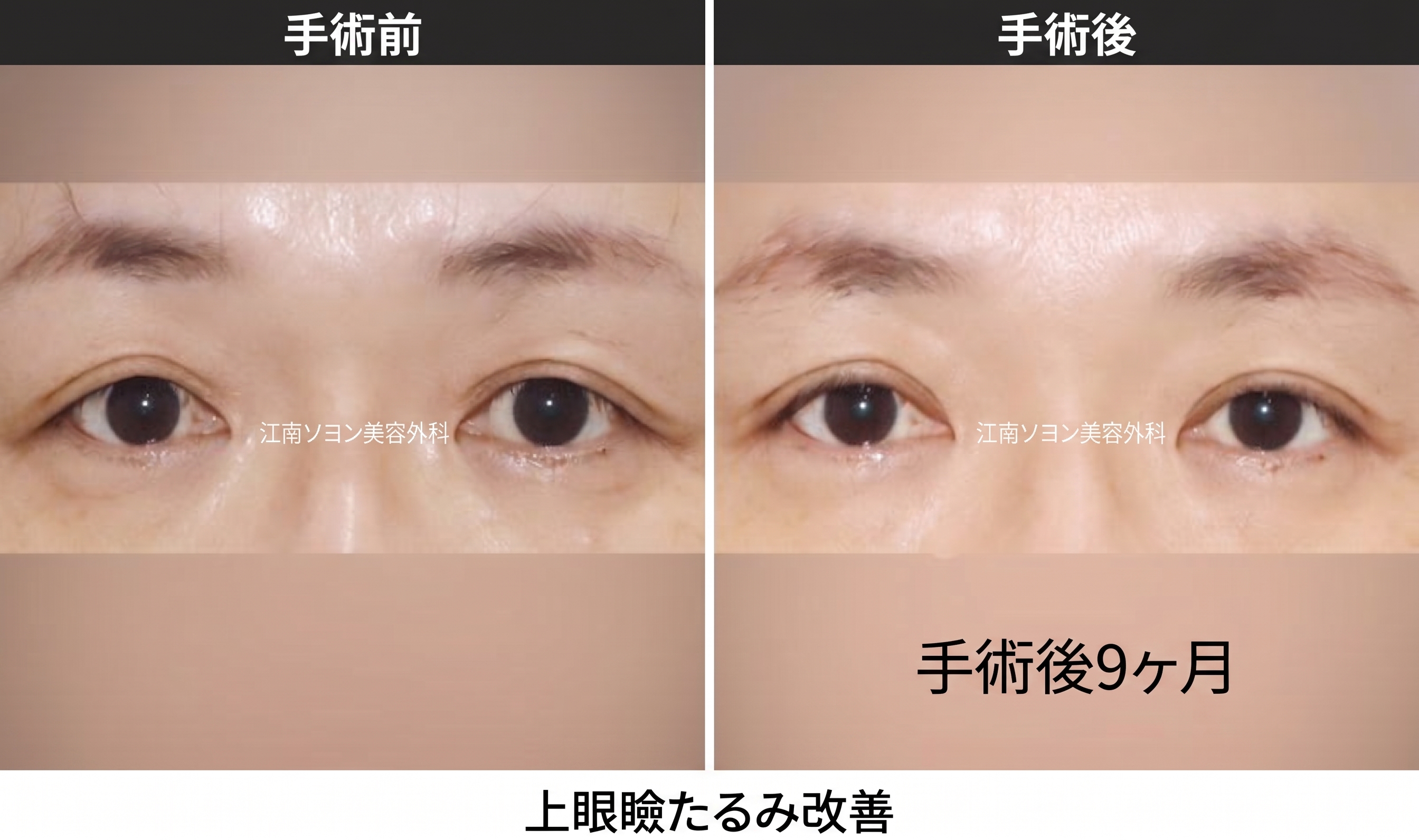 中高年の目元整形の種類、上眼瞼・下眼瞼・眉下リフトはどう違うのでしょうか
