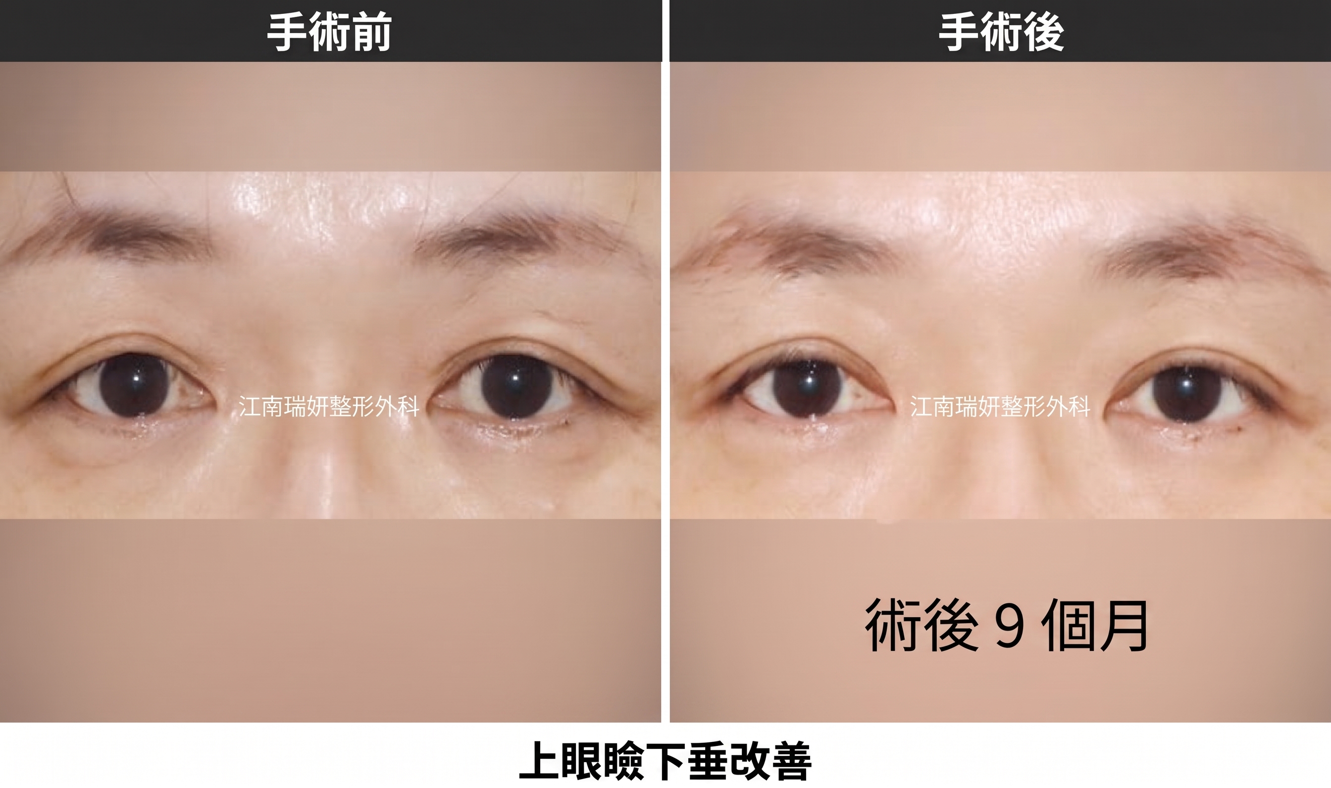 中年眼整形有哪些種類？上眼瞼、下眼瞼與眉下提拉術有何不同