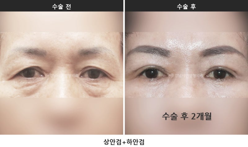 Các loại phẫu thuật tạo hình mắt cho người trung niên: chỉnh mí trên, mí dưới và nâng da dưới chân mày khác nhau thế nào