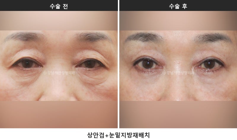 중년 눈처짐 수술, 눈 짓무름과 시야가림이 있다면 상안검을 확인하세요 사진 4