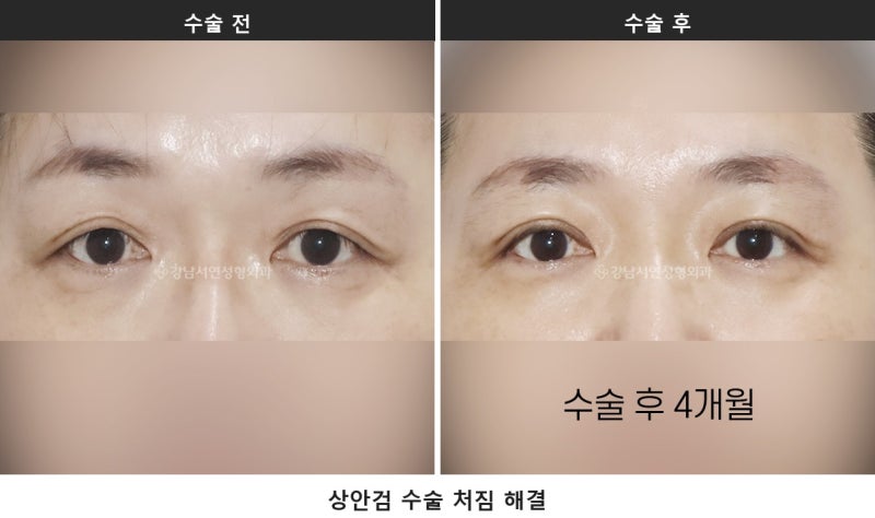 중년 눈처짐 수술, 눈 짓무름과 시야가림이 있다면 상안검을 확인하세요