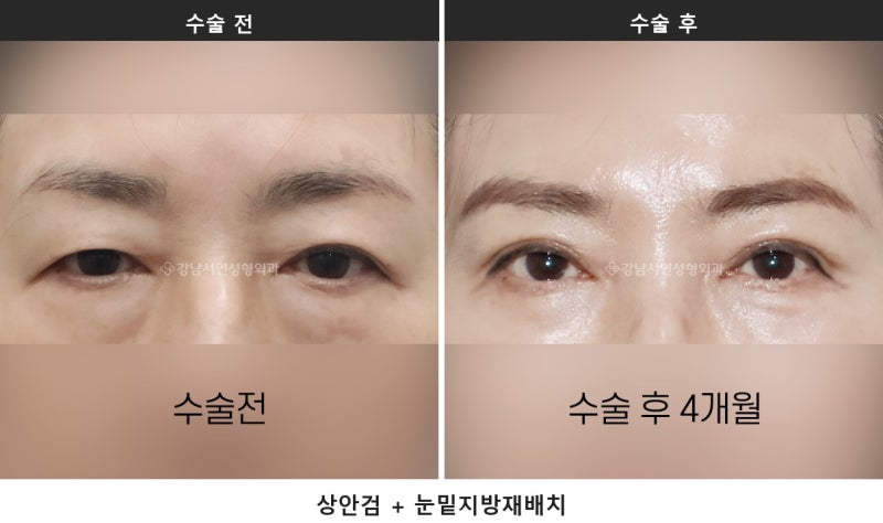 중년 눈처짐 수술, 눈 짓무름과 시야가림이 있다면 상안검을 확인하세요 사진 3