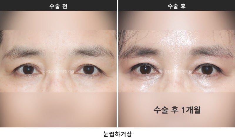 중년 눈처짐 수술, 눈 짓무름과 시야가림이 있다면 상안검을 확인하세요 사진 6