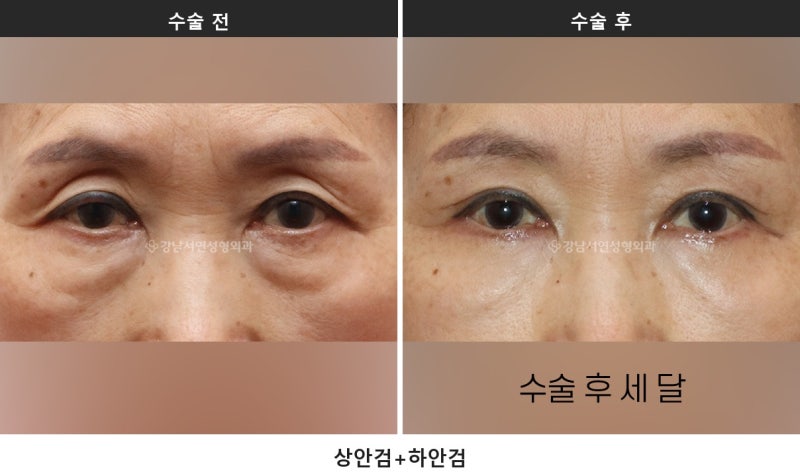 중년 눈처짐 수술, 눈 짓무름과 시야가림이 있다면 상안검을 확인하세요 사진 5