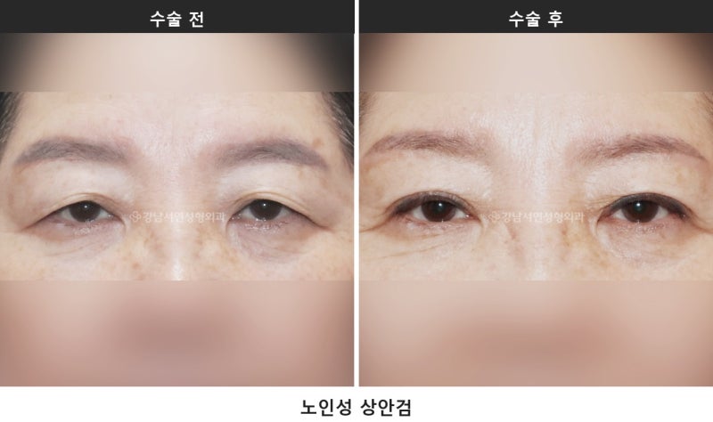 중년 눈처짐 수술, 눈 짓무름과 시야가림이 있다면 상안검을 확인하세요 사진 2
