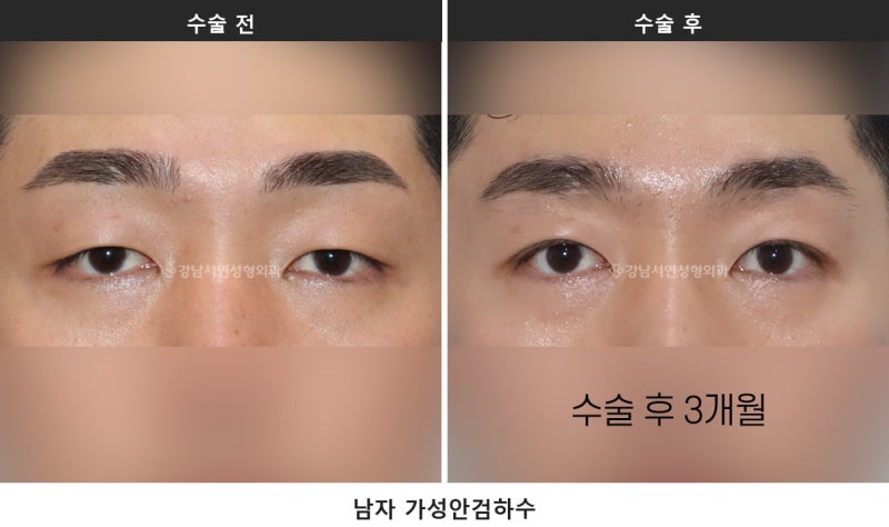 안검하수 뜻, 눈 뜨는 힘이 약해 눈이 가려지는 상태입니다 사진 3