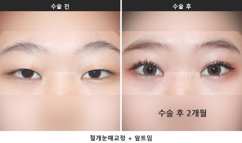 안검하수 뜻, 눈 뜨는 힘이 약해 눈이 가려지는 상태입니다 사진 4