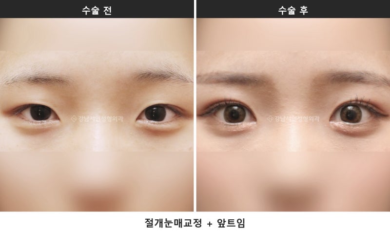 안검하수 뜻, 눈 뜨는 힘이 약해 눈이 가려지는 상태입니다 사진 5
