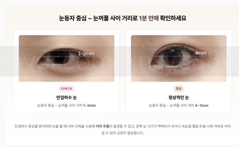 안검하수 뜻, 눈 뜨는 힘이 약해 눈이 가려지는 상태입니다