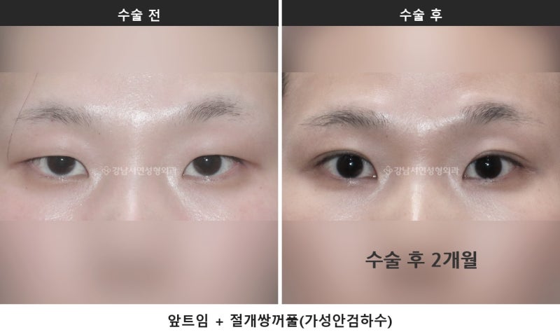 안검하수 뜻, 눈 뜨는 힘이 약해 눈이 가려지는 상태입니다