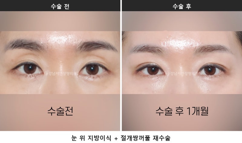 눈두덩이 꺼짐 쌍수, 원인이 유착인지 볼륨 부족인지부터 구분합니다