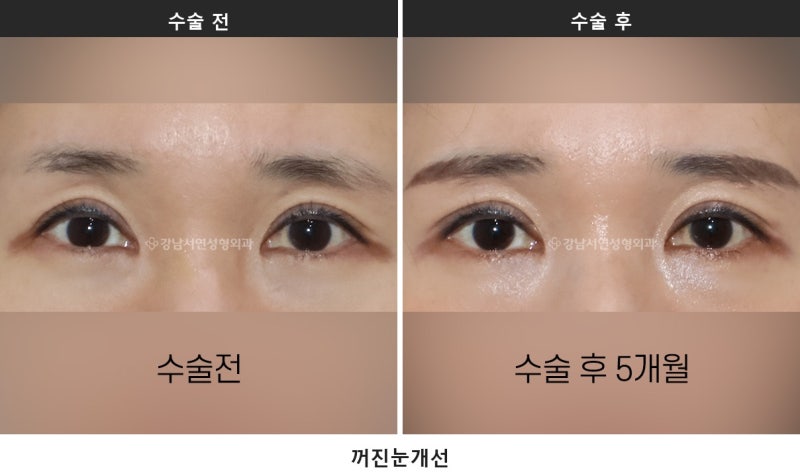 눈두덩이 꺼짐 쌍수, 원인이 유착인지 볼륨 부족인지부터 구분합니다 사진 2