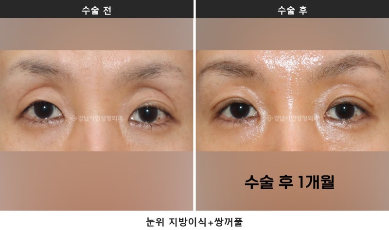 눈두덩이 꺼짐 쌍수, 원인이 유착인지 볼륨 부족인지부터 구분합니다 사진 4
