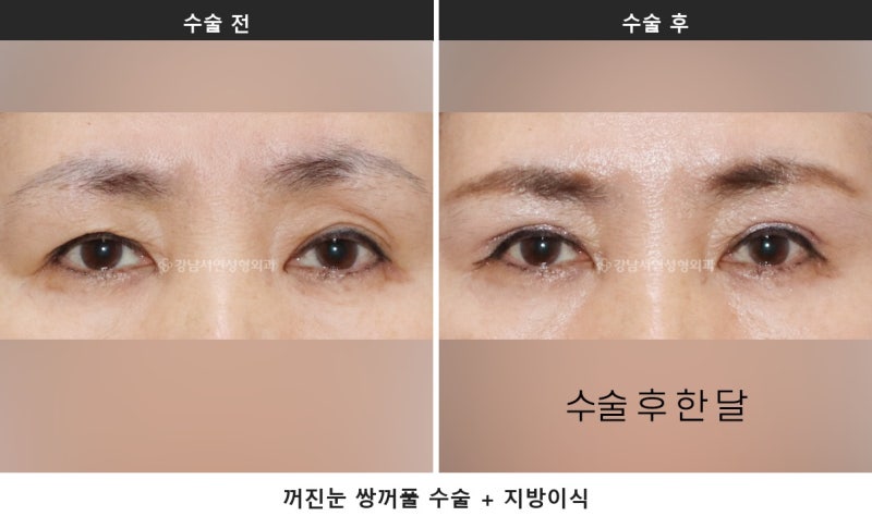 눈두덩이 꺼짐 쌍수, 원인이 유착인지 볼륨 부족인지부터 구분합니다 사진 3