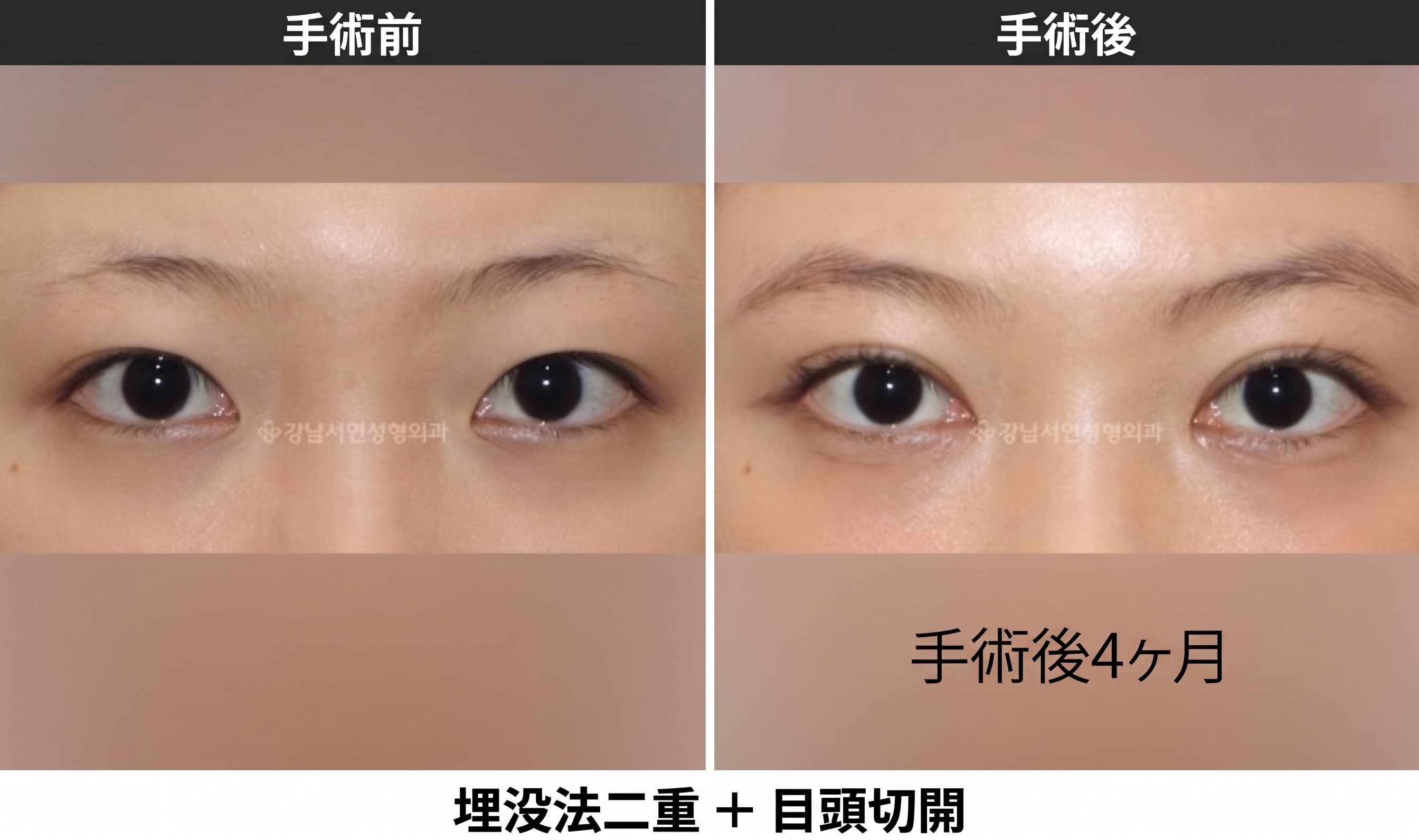 二重整形の種類、埋没法と切開法はこんなに違います