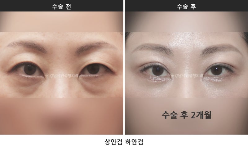중년 눈성형, 눈이 처져 보이는 원인은 네 가지로 나뉩니다 사진 2