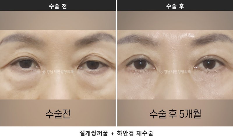 중년 눈성형, 눈이 처져 보이는 원인은 네 가지로 나뉩니다 사진 3