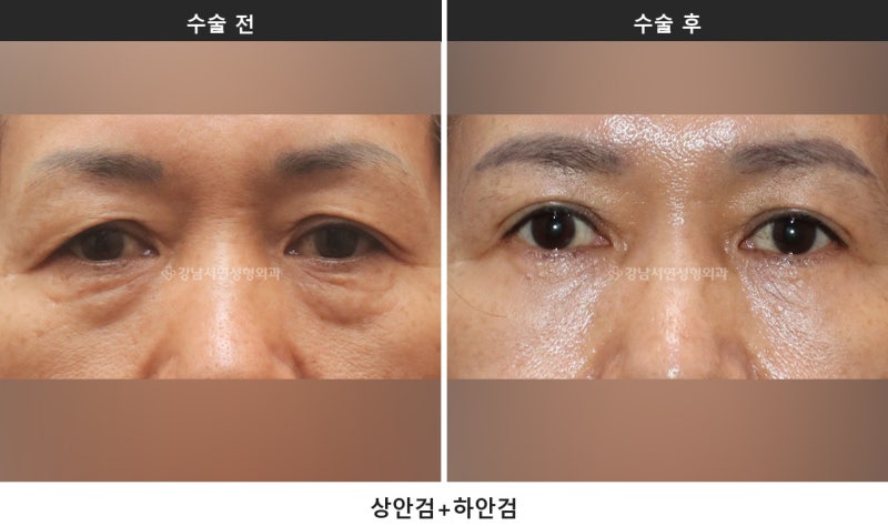 중년 눈성형, 눈이 처져 보이는 원인은 네 가지로 나뉩니다 사진 4